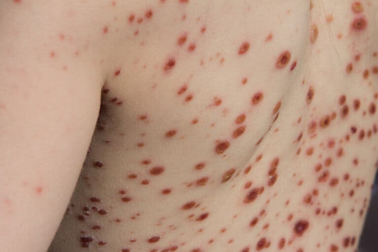 Viruela del mono o mpox: causas, síntomas, diagnóstico y tratamiento