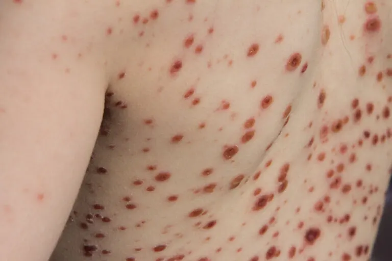 Viruela del mono o mpox: causas, síntomas, diagnóstico y tratamiento