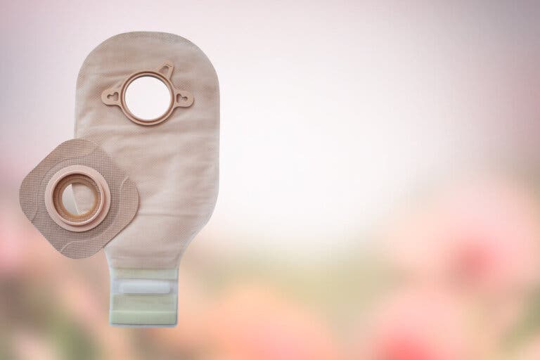 17 consejos para vivir con una ileostomía