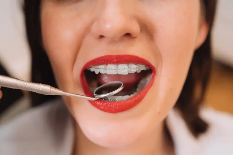 Brackets de cerámica y de zafiro: ventajas y diferencias