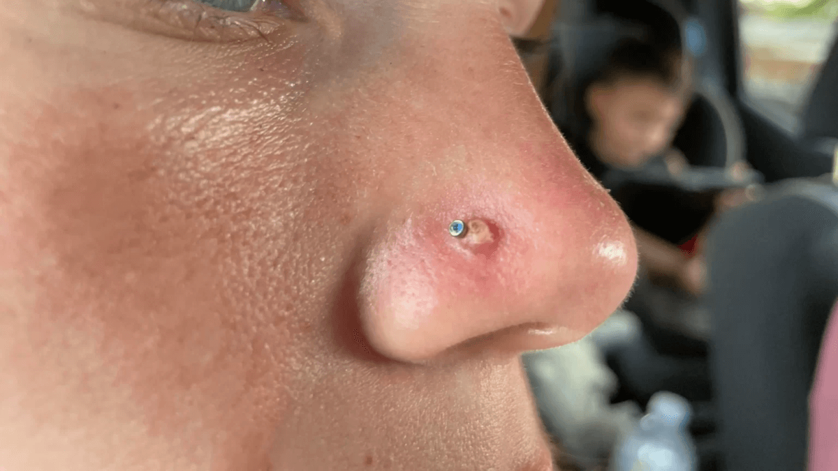 Bulto en un piercing en la nariz.