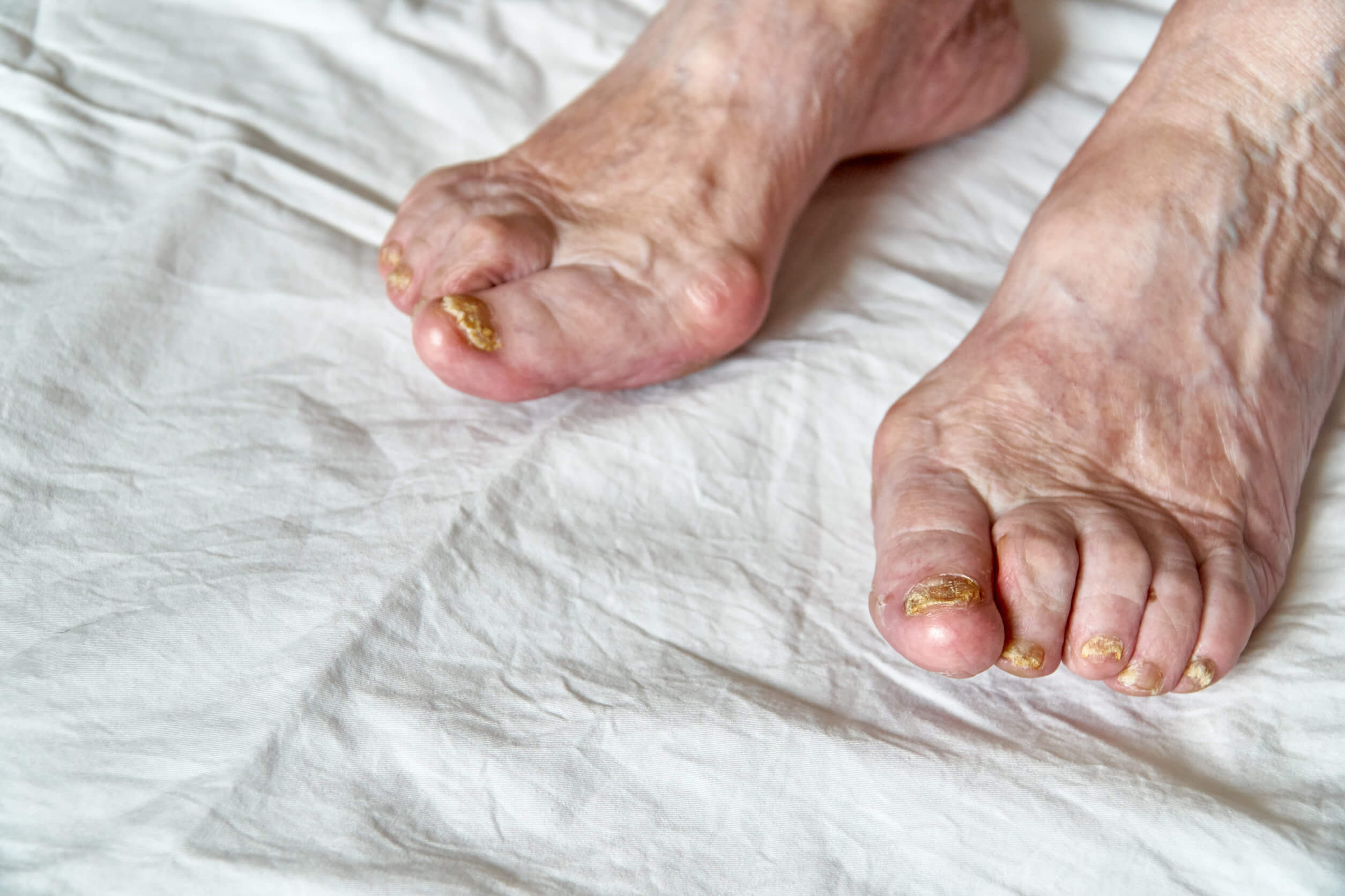 Anatomie des Fußes - Füße eines älteren Menschen