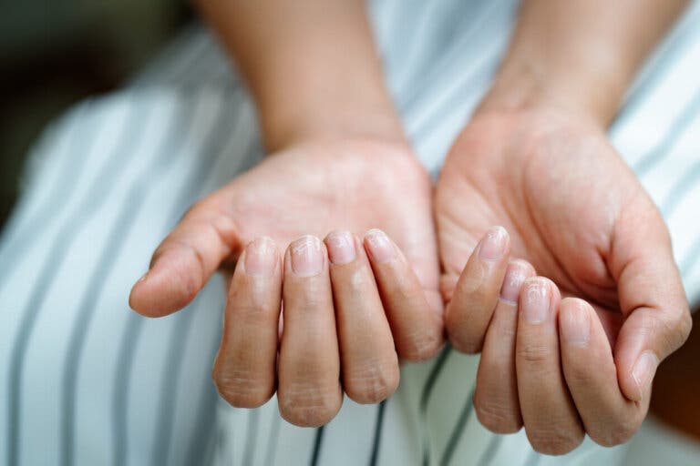 ¿Por qué aparecen las estrías en las uñas?