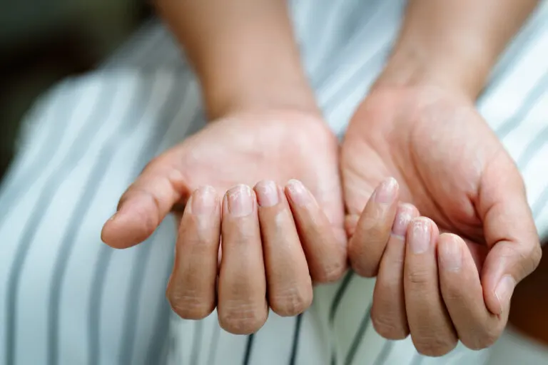 ¿Por qué aparecen las estrías en las uñas?
