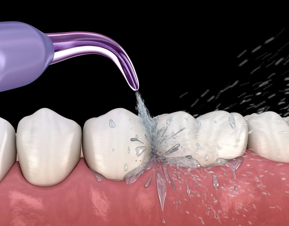 Irrigador dental en la limpieza con ultrasonido.