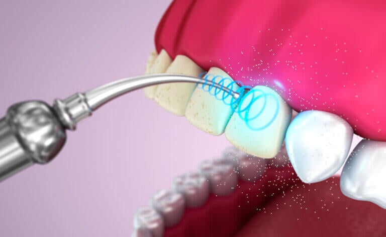 Limpieza dental por ultrasonido: ventajas y desventajas