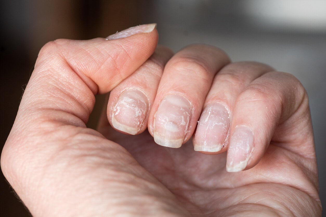Vergetures sur les ongles.
