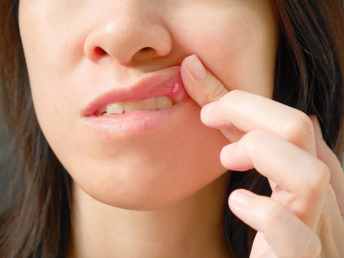 Eksempel på papillomer i munden