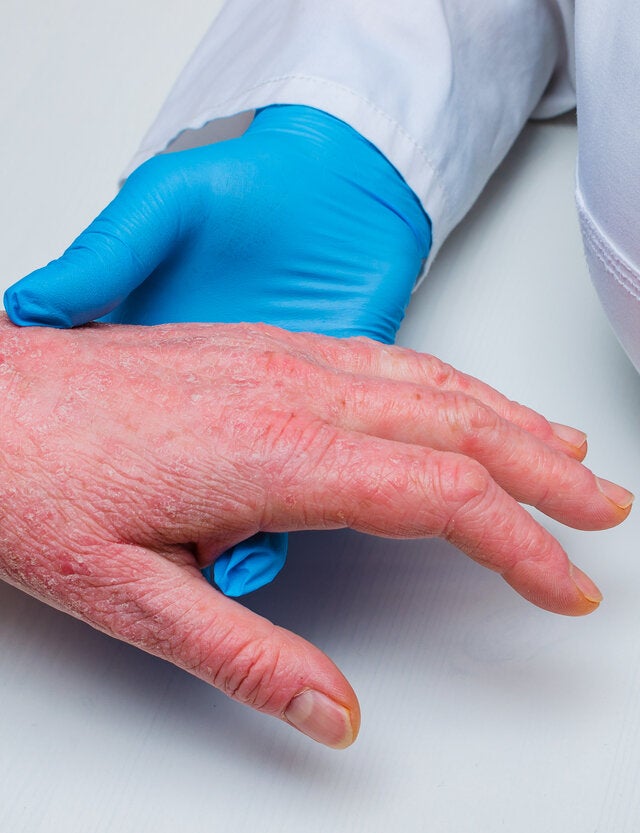 Hermano Mentalidad Vegetación Síntomas y tratamientos de la dermatitis en las manos - Mejor con Salud