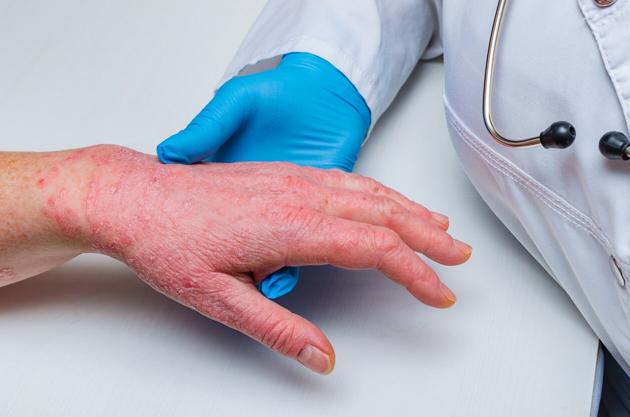 Dermatite sur les mains.