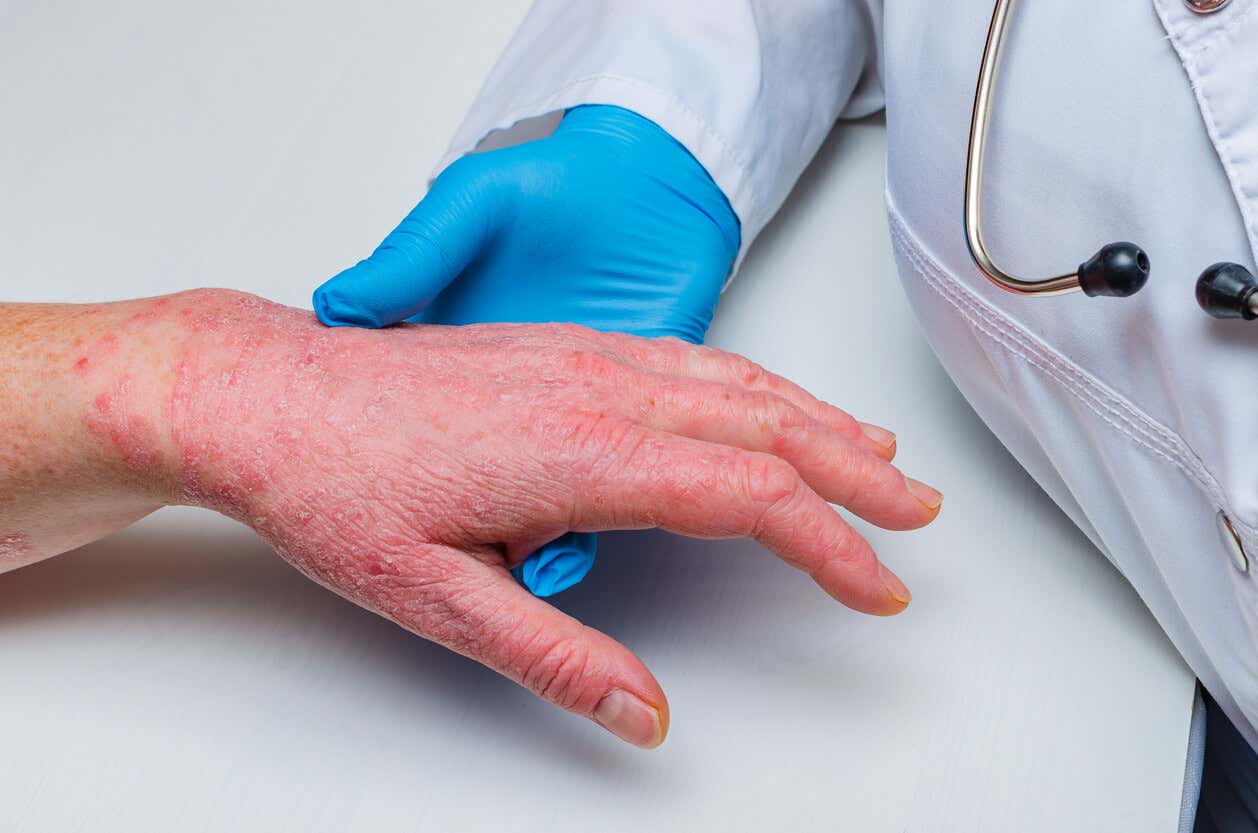 Dermatitis en las manos.