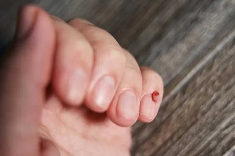 ¿Cómo reconocer los tumores en las uñas?