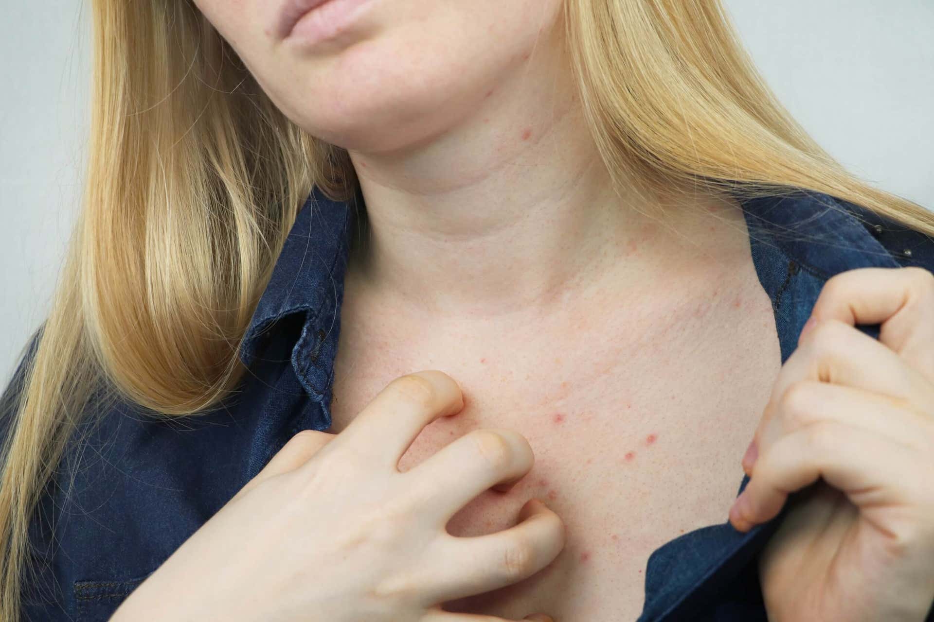 Vrouw met een allergische reactie