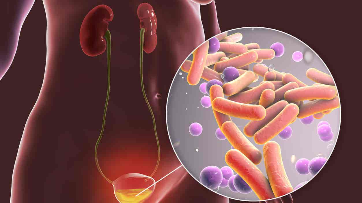 Infecciones del tracto urinario (ITU) síntomas y causas Mejor con Salud Infecciones del tracto urinario (ITU) síntomas y causas Mejor con Salud
