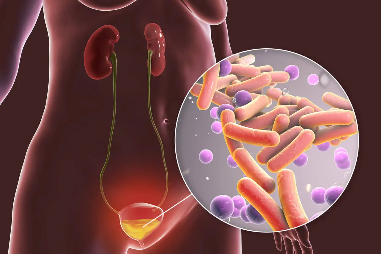Bacterias en la orina causan quiste de Bartolino.