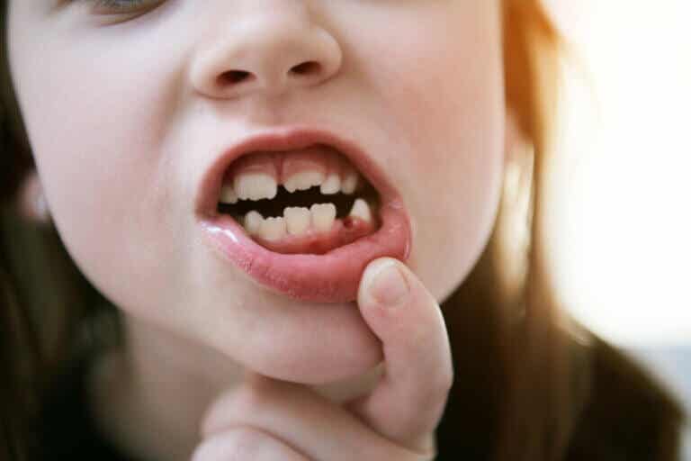 Muelas de los 6 aos: primeros dientes permanentes en nios