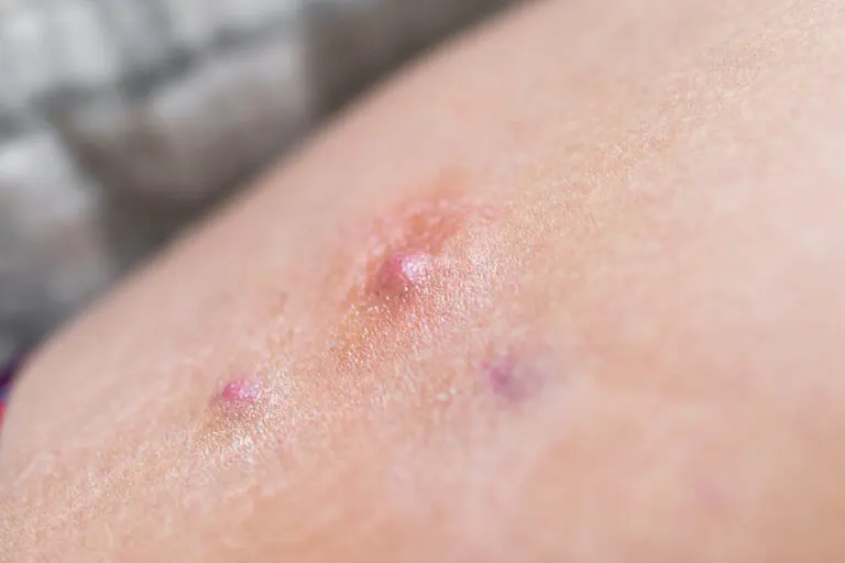 ¿Por qué es malo reventar la hidradenitis supurativa?