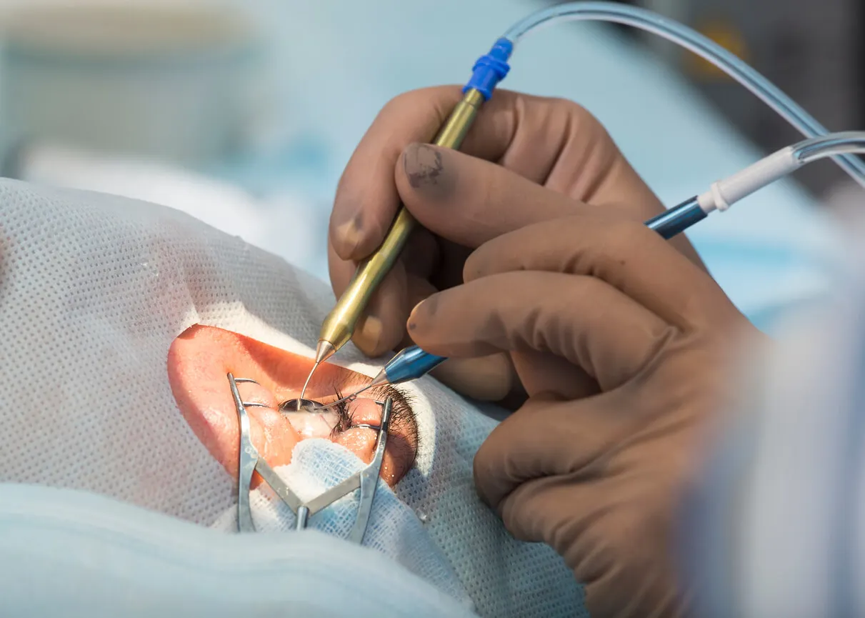 Cirurgia de lentes intraoculares.