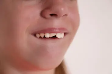 Golpe en los dientes de leche: ¿qué debemos hacer?
