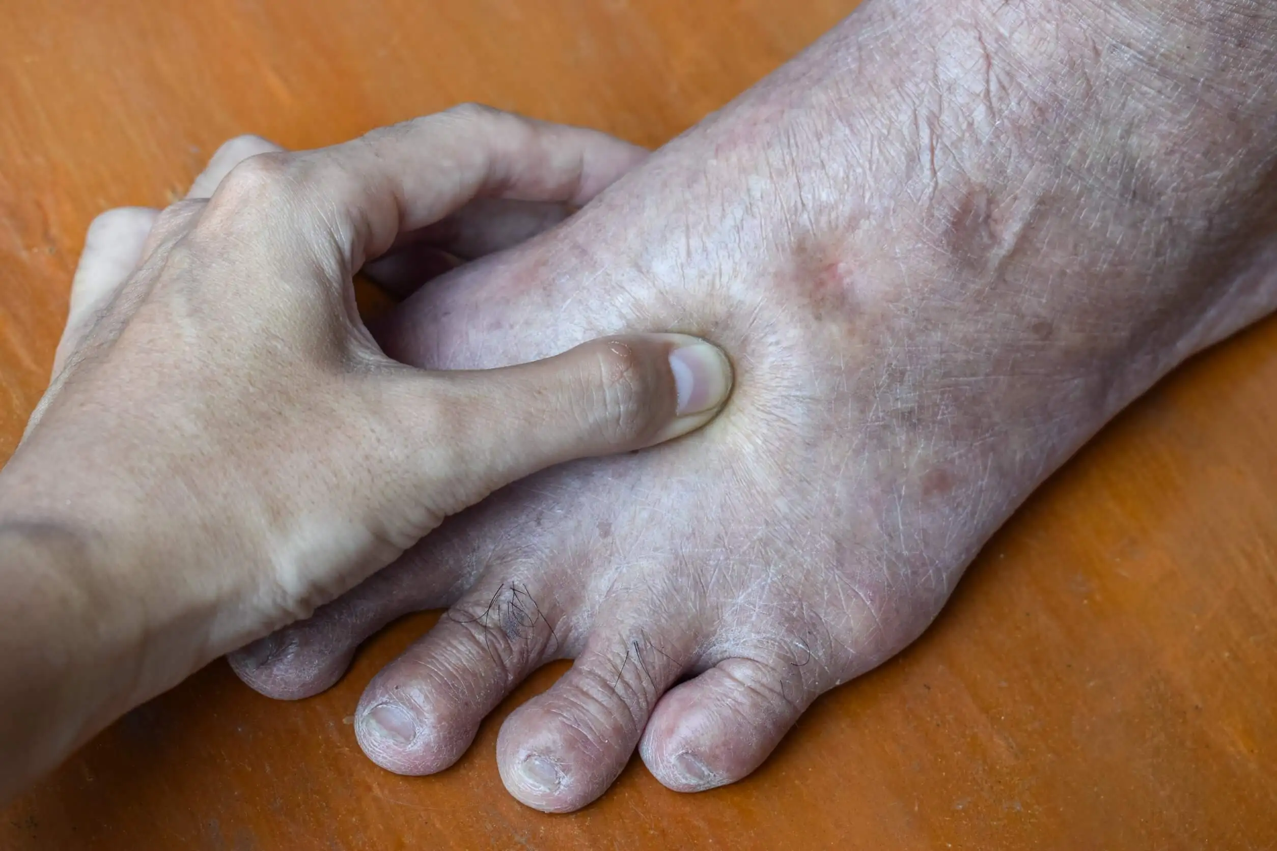 Edema trattato con gramigna.