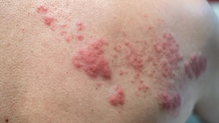 El 90 % de los españoles portan el virus de la varicela-zóster