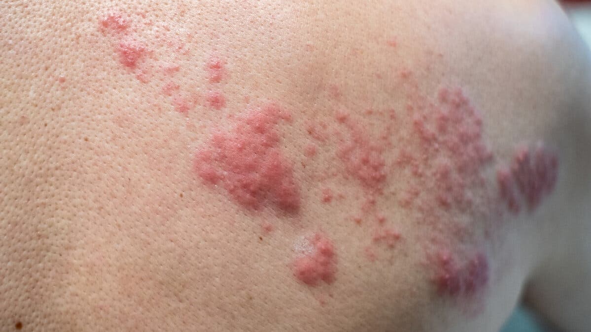 Herpes zóster.