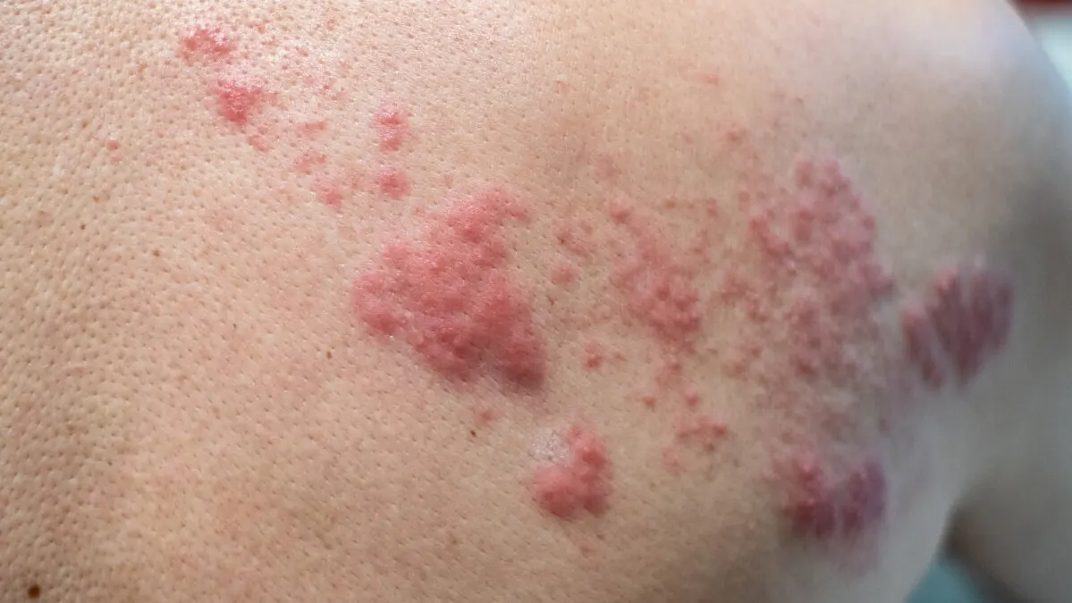 Herpes zóster.