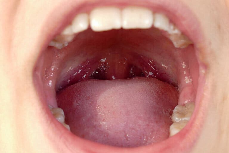 Cómo prevenir y eliminar los cálculos de las amígdalas en casa