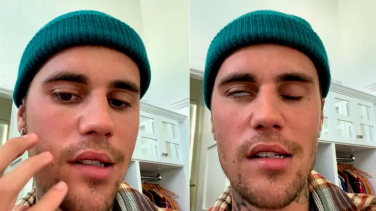 Justin Bieber tiene el síndrome de Ramsay Hunt y suspende su gira: ¿de qué se trata esta enfermedad?