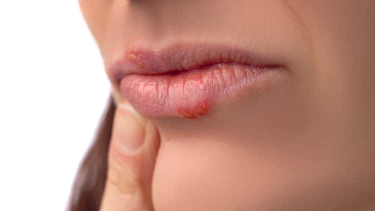 Traitements et soins contre la perlèche