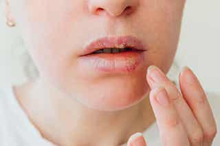 Tratamientos y cuidados contra las boqueras