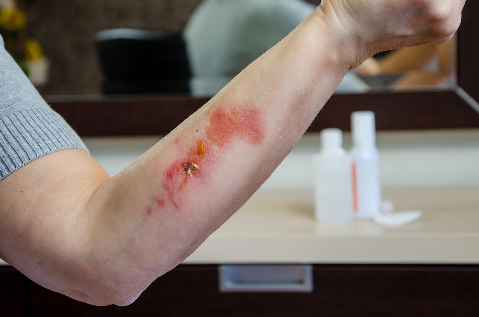 Man met een wond aan zijn arm