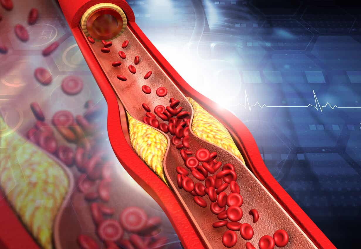 Colesterol en las arterias.