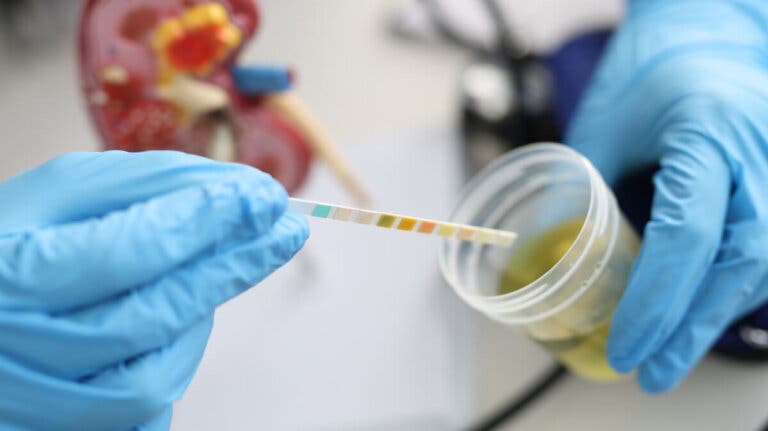 Urobilinógeno en orina: causas y valores normales