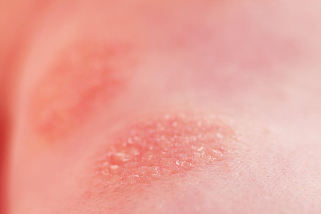 Chilli Rash Alergia al chocolate: causas, tratamientos y prevención - Mejor con Salud