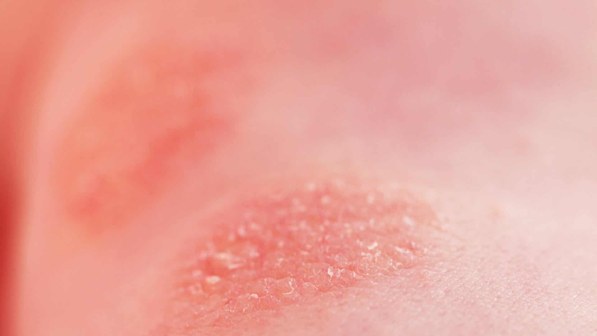 Allergia Al Cioccolato Cause Trattamenti E Prevenzione allergia-al-cioccolato-cause-trattamenti-e-prevenzione