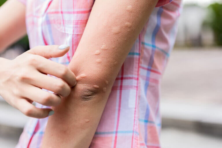 Sarpullido o brote en el brazo: posibles causas y tratamientos