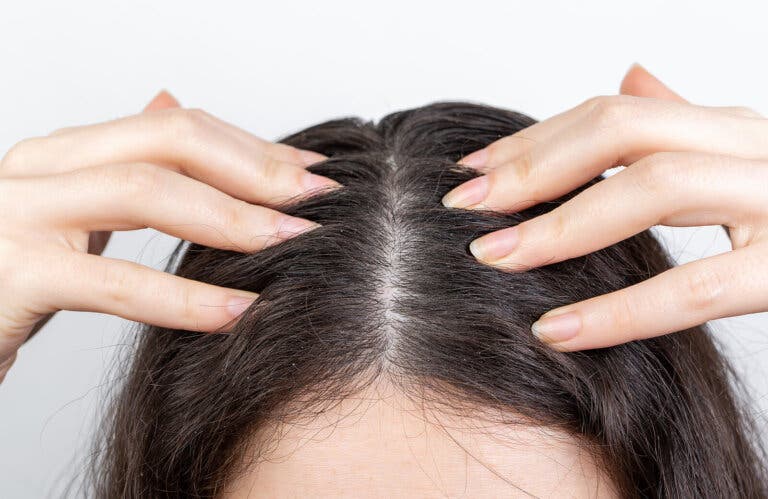 Hiperhidrosis capilar: ¿qué puede ayudar a controlarlo?