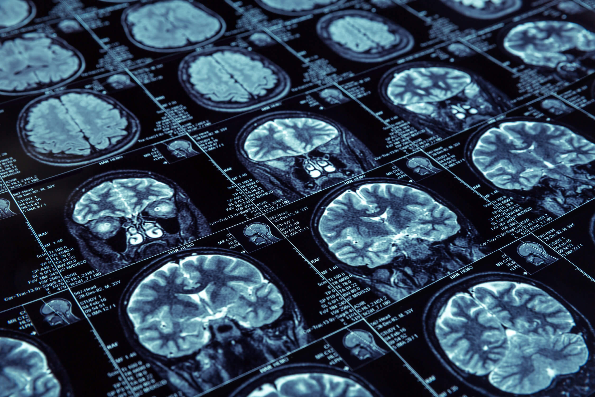Die Alzheimer-Krankheit - MRT-Bilder eines Gehirns