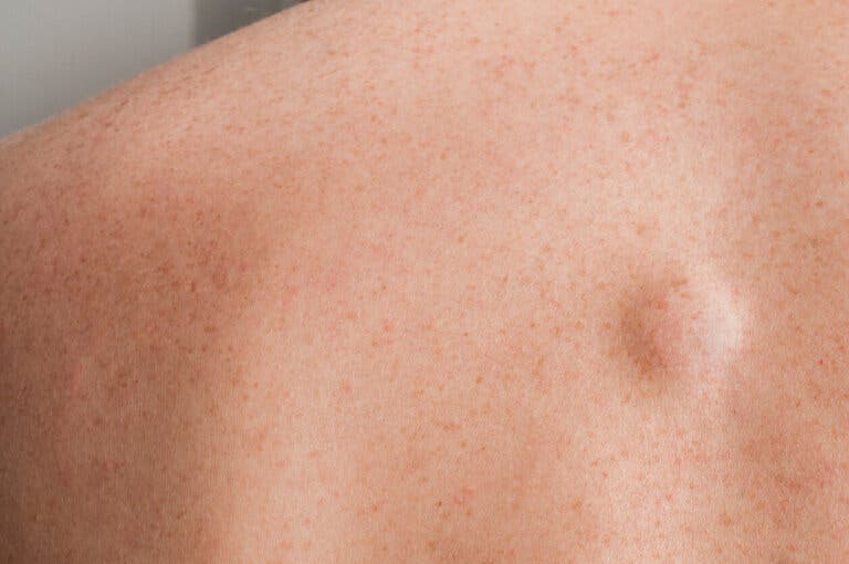 Bola o bulto en la espalda: 9 posibles causas