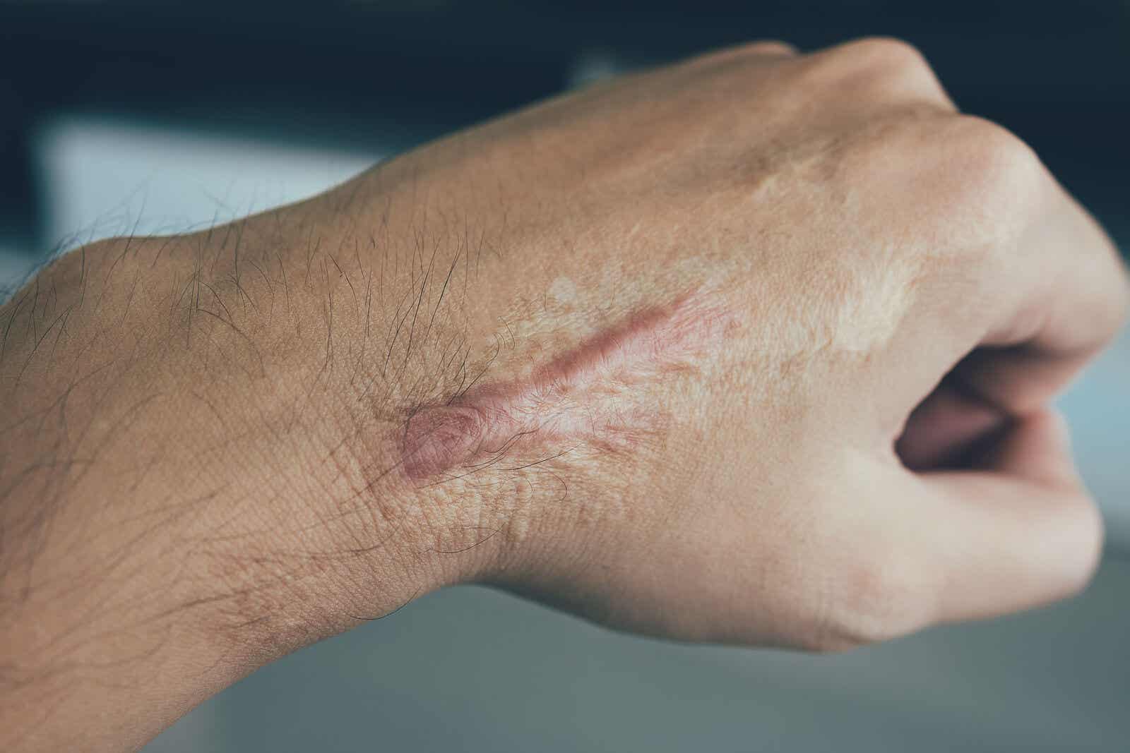 What is a keloid scar?