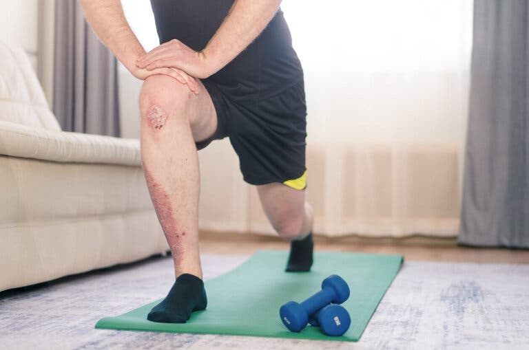 Beneficios del ejercicio físico para la psoriasis