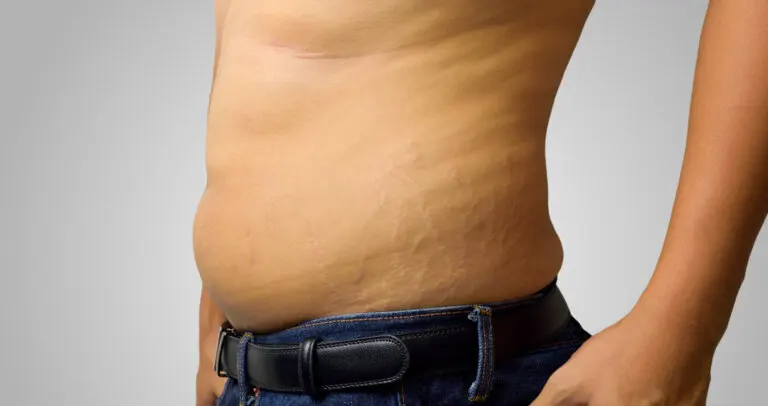 Estrías en hombres: causas y cómo reducirlas naturalmente
