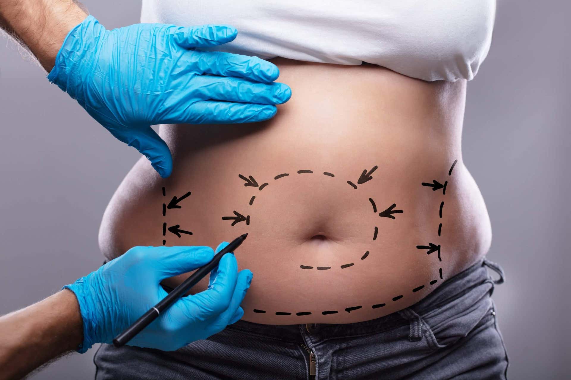 BodyTite - Bauch einer Frau wird mit Filzstift markiert