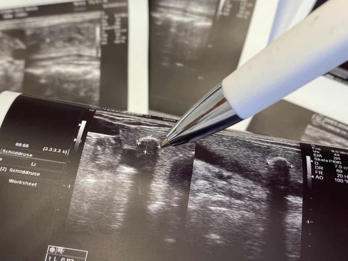 ultraschallgesteuerte Filler - Kugelschreiber deutet auf ein Ultraschallbild
