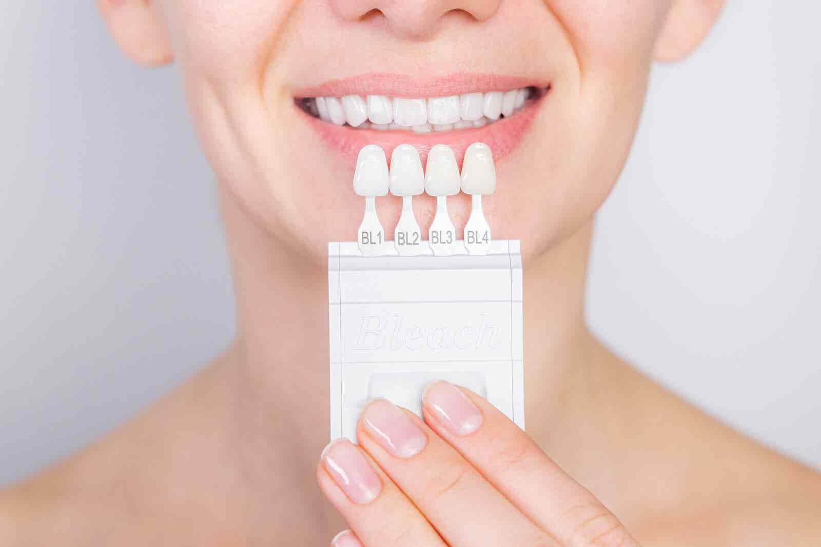 Carillas dentales que necesitan grabado ácido.