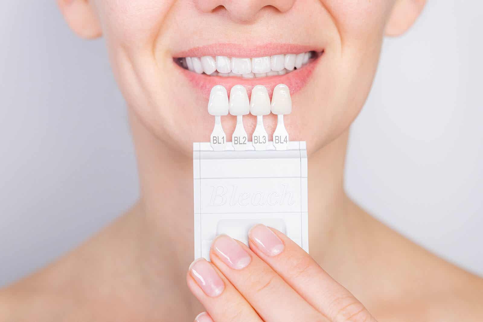 Facettes dentaires nécessitant un mordançage à l'acide.