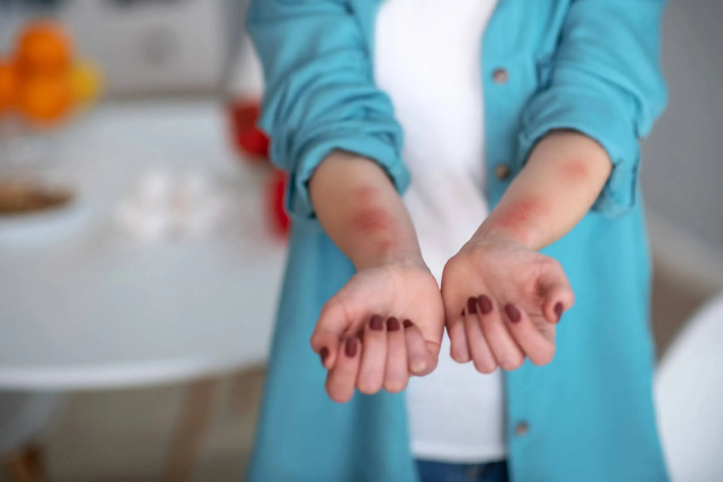 Almidón de maíz para la urticaria