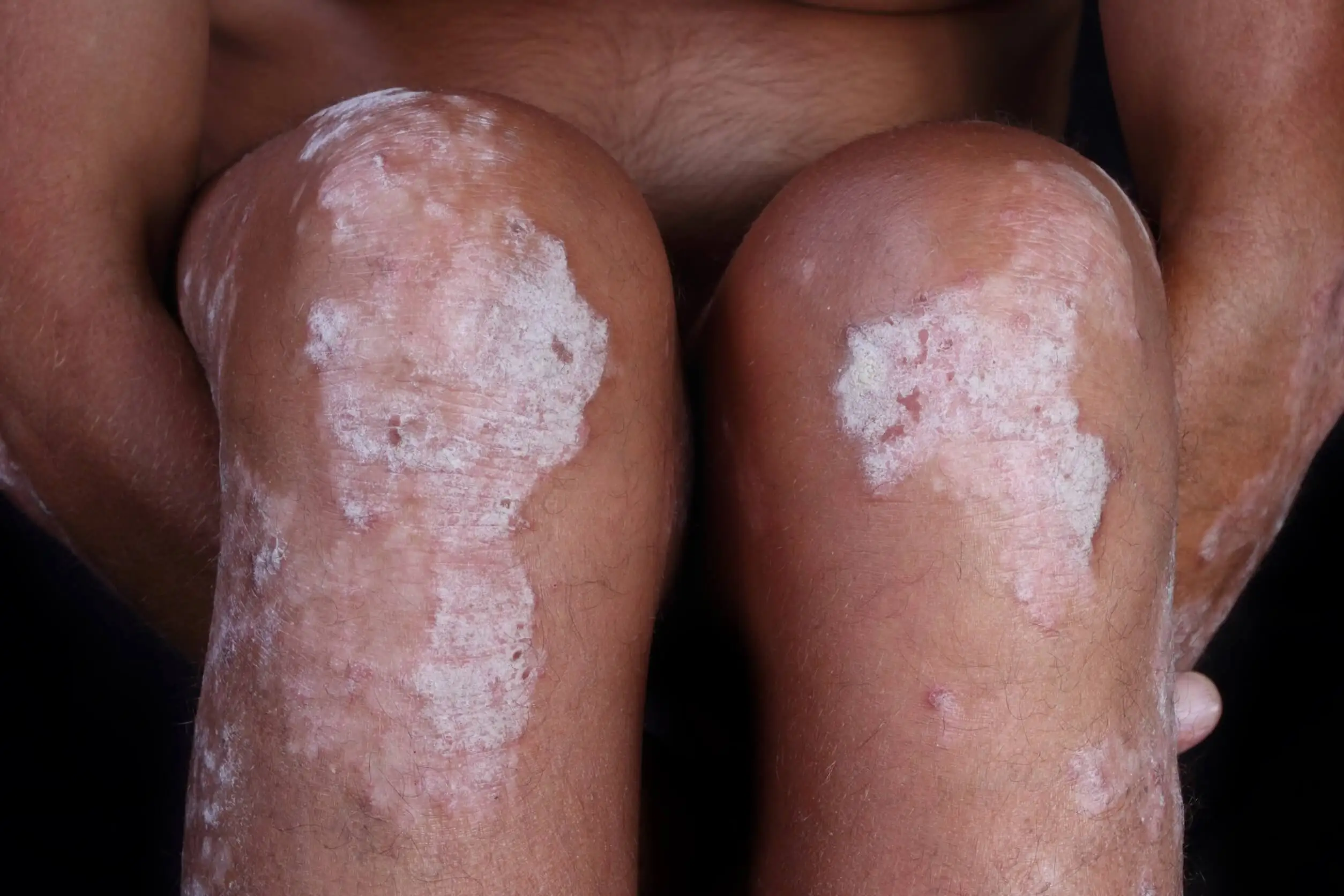 Psoriasis