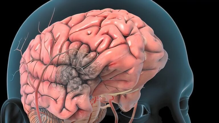Trombosis arterial cerebral: qué es, causas, síntomas y tratamiento